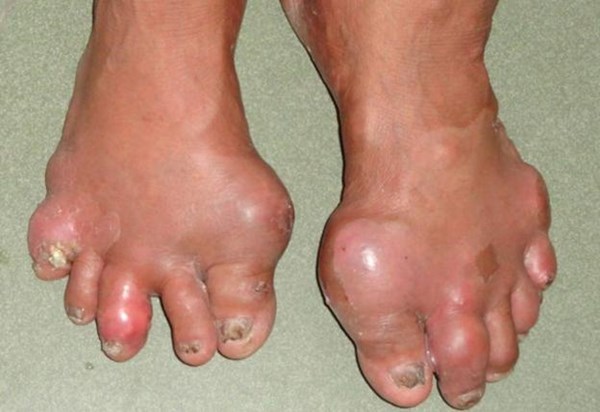 Kết quả hình ảnh cho bệnh gout
