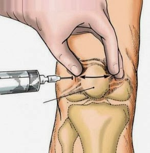 CÁC BIỆN PHÁP PHÒNG CHỐNG BỆNH ĐAU KHỚP GỐI CÁC BIỆN PHÁP PHÒNG CHỐNG BỆNH ĐAU KHỚP GỐI