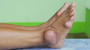 5-risk-factors-for-gout-01-722x406