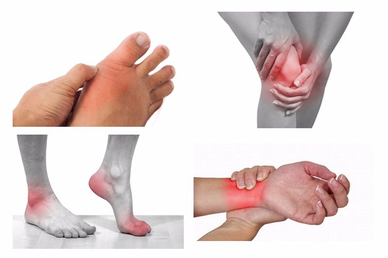 triệu chứng viêm khớp Viêm khớp có thể xảy ra ở nhiều vị trí trên cơ thể
