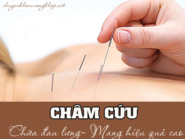 châm cứu chữa đau - châm cứu đau thắt lưng