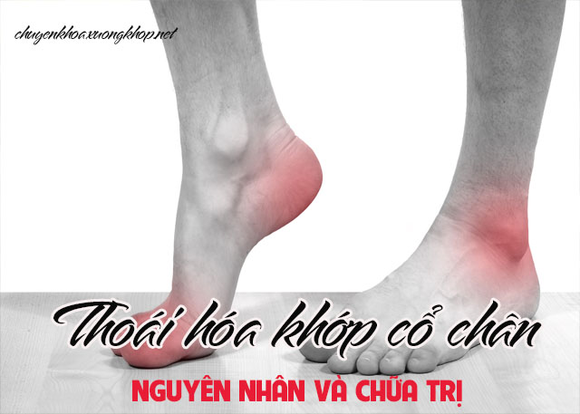 Thoái hóa khớp cổ chân