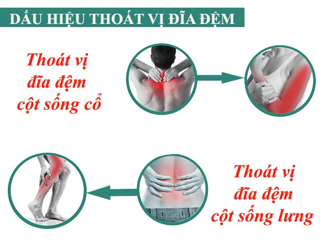 Biểu hiện thoát vị đĩa đệm