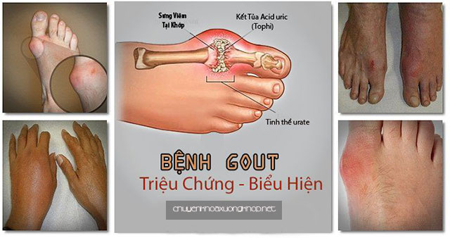 Biểu hiện của người bị bệnh Gout (Gút)