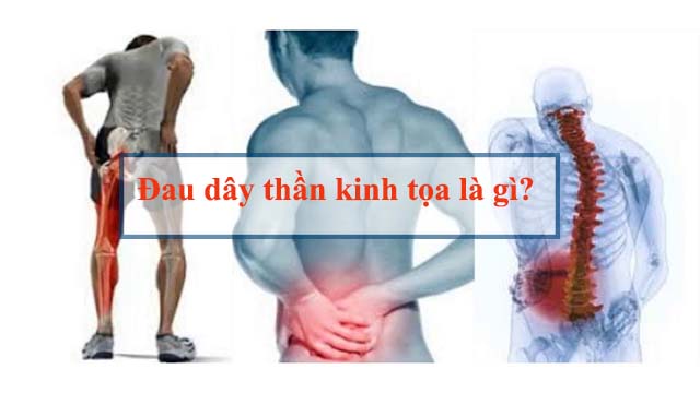 Đau dây thần kinh tọa