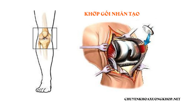 Thay khớp gối nhân tạo giá bao nhiêu?