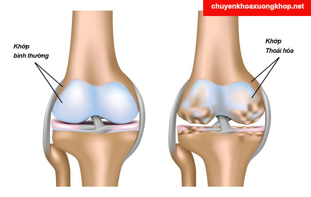 Thoái hóa khớp gây đau đầu gối ở người trẻ