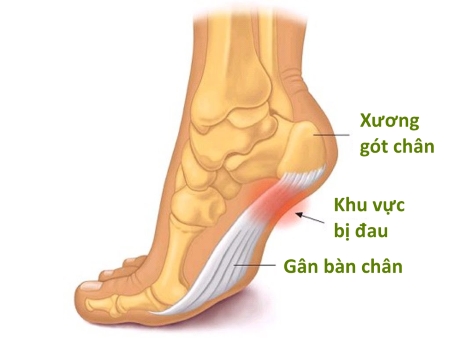 Kết quả hình ảnh cho đau gót chân