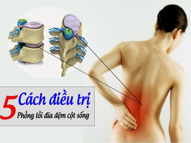 Phồng lồi đĩa đệm cột sống Phồng lồi đĩa đệm cột sống