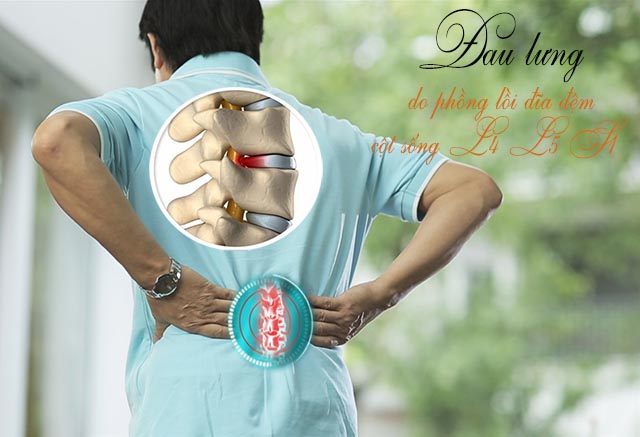 Triệu chứng phồng lồi đĩa đệm cột sống L4 L5 S1 Triệu chứng phồng lồi đĩa đệm cột sống L4 L5 S1