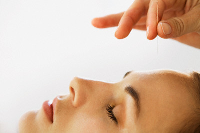 Young Woman Getting Acupuncture Treatment --- Image by © Mina Chapman/Corbis