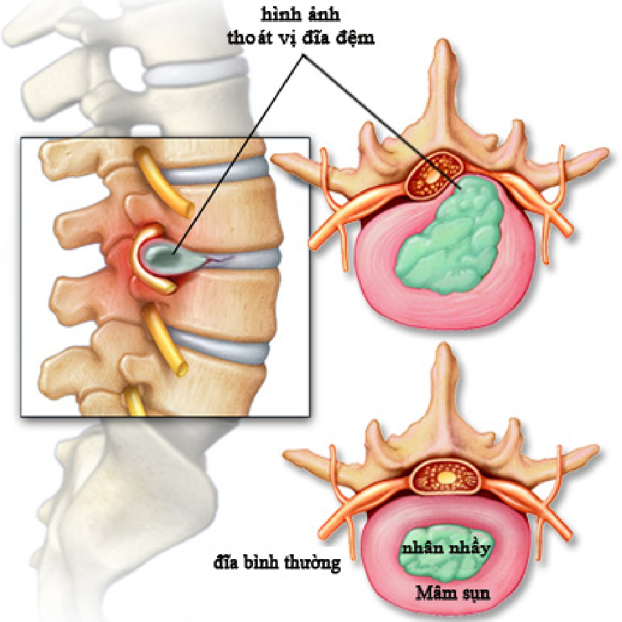 thoát vị đĩa đệm mất nước