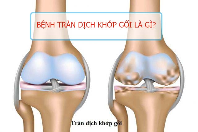 Bệnh tràn dịch khớp gối Bệnh tràn dịch khớp gối