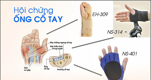 Biến cứng phong thấp hội chứng ống cổ tay