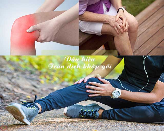 Dấu hiệu tràn dịch khớp gối Dấu hiệu tràn dịch khớp gối