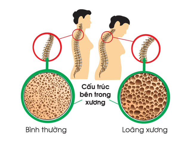 Loãng xương biến chứng bệnh phong thấp