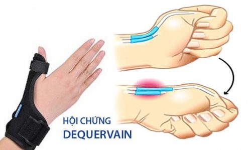 Hội chứng De Quervain Hội chứng De Quervain