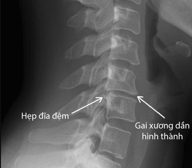 Triệu chứng gai đôi cột sống không phải ai cũng biết