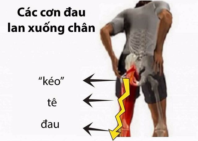 Triệu chứng gai đôi cột sống không phải ai cũng biết