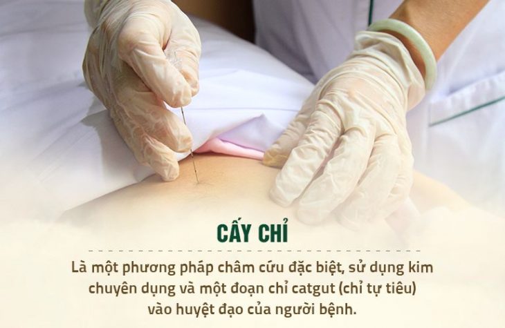 Cấy chỉ là phương pháp được cải tiền từ kỹ thuật châm cứu