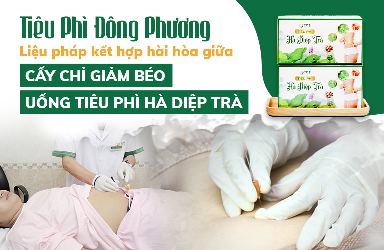 Liệu trình cấy chỉ giảm béo Tiêu Phì Đông Phương 