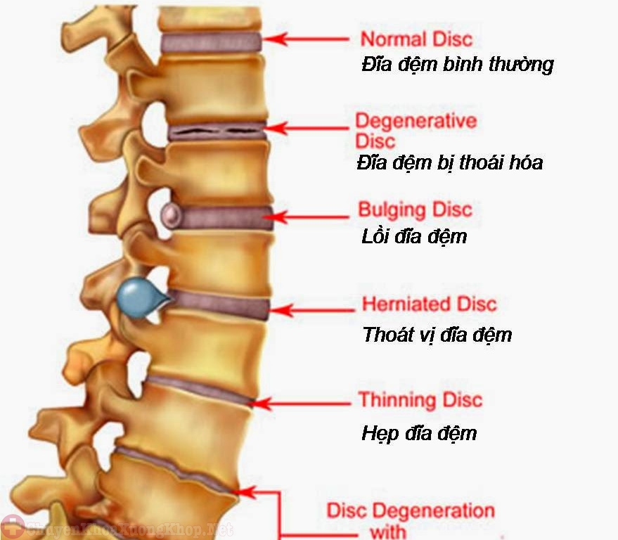 Bệnh phình đĩa đệm