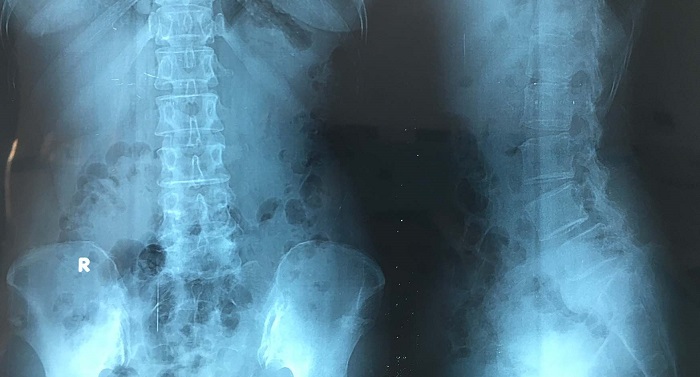 chụp x quang thoái hóa cột sống thắt lưng