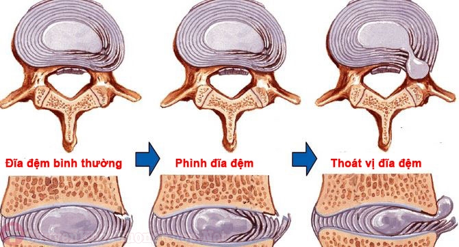 Phồng đĩa đệm dẫn tới thoát vị đĩa đệm