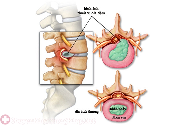 Bệnh thoát vị đĩa đệm