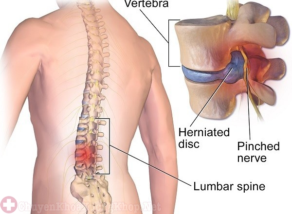 Xẹp đĩa đệm cột sống gây ra tình trạng đau nhức trong xương