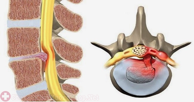 Bệnh xẹp đĩa đệm cột sống