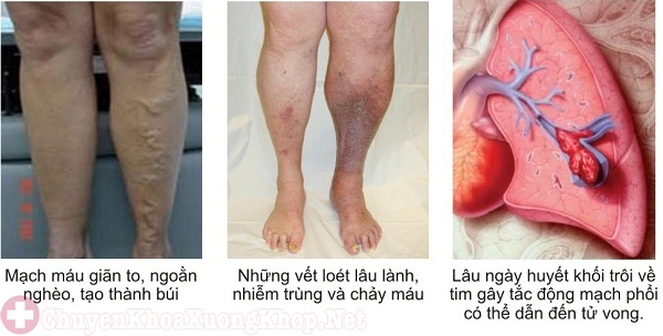 Viêm tắc tĩnh mạch, gây đông máu