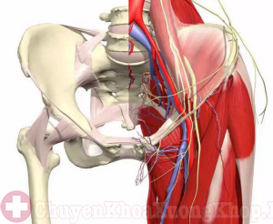 Nhiễm trùng sau khi phẫu thuật thay khớp háng