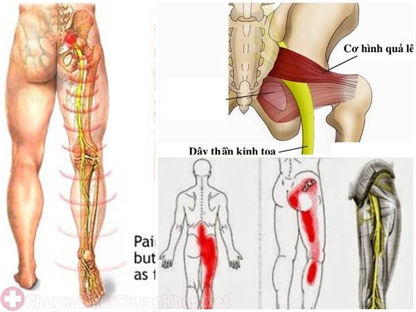 Tổn thương dây thần kinh tọa