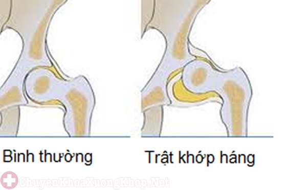 Trật khớp háng sau phẫu thuật