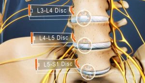 Cách chữa thoát vị đĩa đệm L5 S1 không cần phẫu thuật