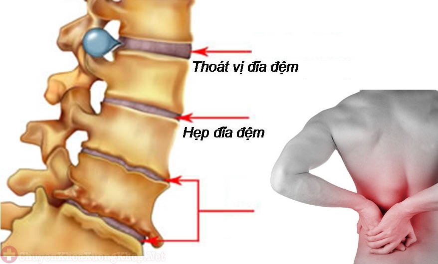 Bệnh thoát vị đĩa đệm