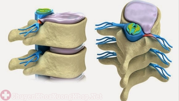 Đĩa đệm bị thoát vị