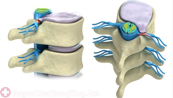 Bệnh thoát vị đĩa đệm