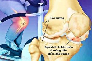 6 dấu hiệu gai khớp gối thường bị xem nhẹ bỏ qua