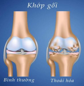 6 dấu hiệu thoái hóa khớp gối vô cùng nguy hiểm
