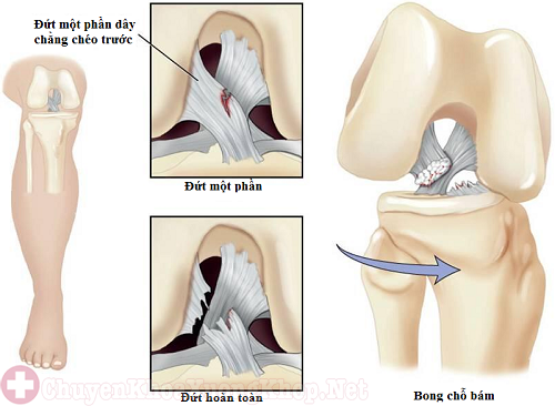 đứt một phần dây chằng chéo trước