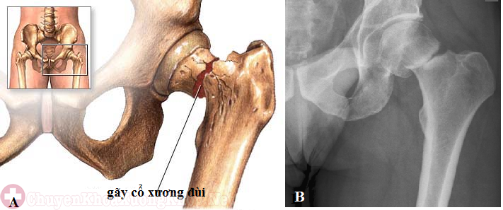 Thay khớp háng bán phần