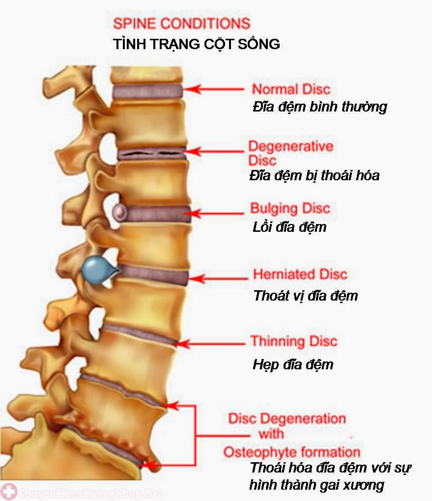 thoái hóa đĩa đệm