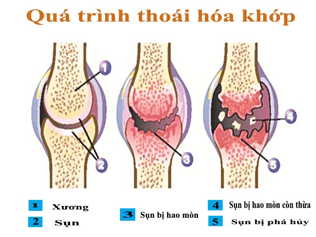 Káº¿t quáº£ hÃ¬nh áº£nh cho NGUYÃN NHÃN GÃY THOÃI HOÃ KHá»P Gá»I