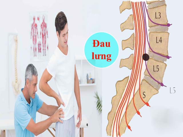 Triệu chứng thoát vị đĩa đệm L5S1 - Chữa thoát vị đĩa đệm L5 S1