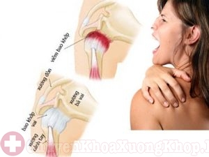 3 bài tập chữa thoái hóa khớp vai hiệu quả đơn giản dễ tập