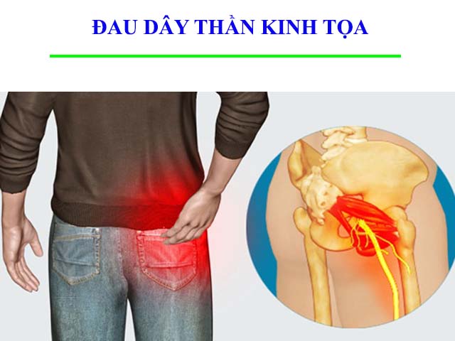 Biểu hiện thoát vị đĩa đệm cột sống thắt lưng