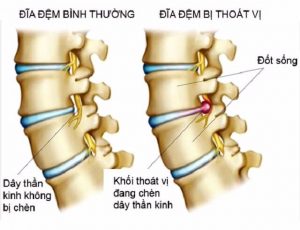 Điều trị thoát vị đĩa đệm cột sống thắt lưng không cần phẫu thuật