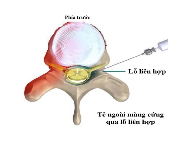 Điều trị thoát vị đĩa đệm cột sống thắt lưng bằng tiêm phong bế